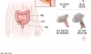 인류의 수명을 거의 두배로 늘려준 수술
