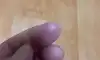 손가락 끝이 멍 든것처럼 붓고 열감이 있어요..왜그럴까요..