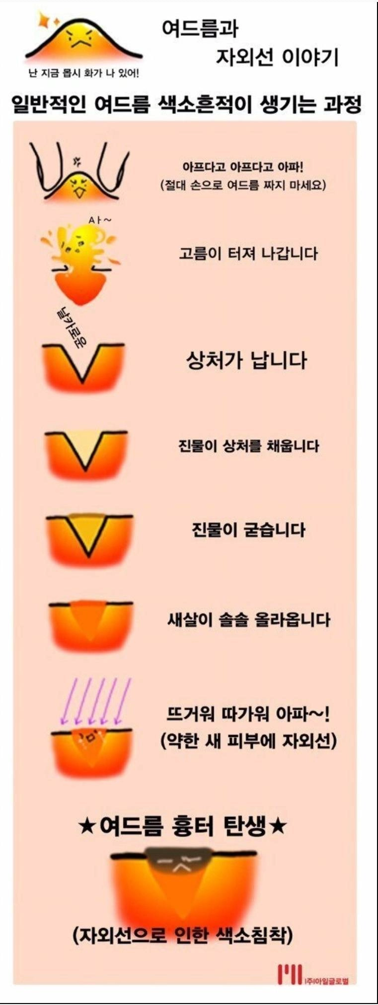 4e220f07f9045047dadd437339272960.webp 여드름 흉터가 생기는 과정