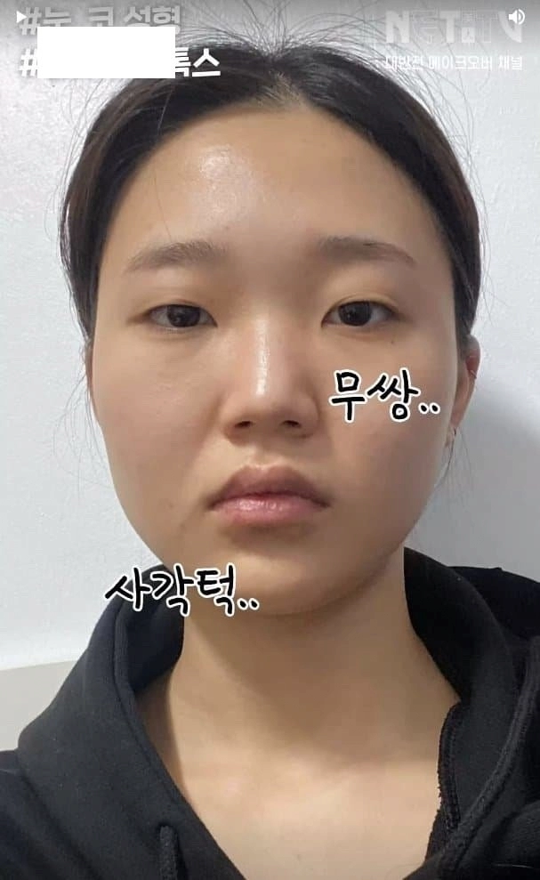 흔한 한국여자의 성형수술 전후사진 ㄷㄷ