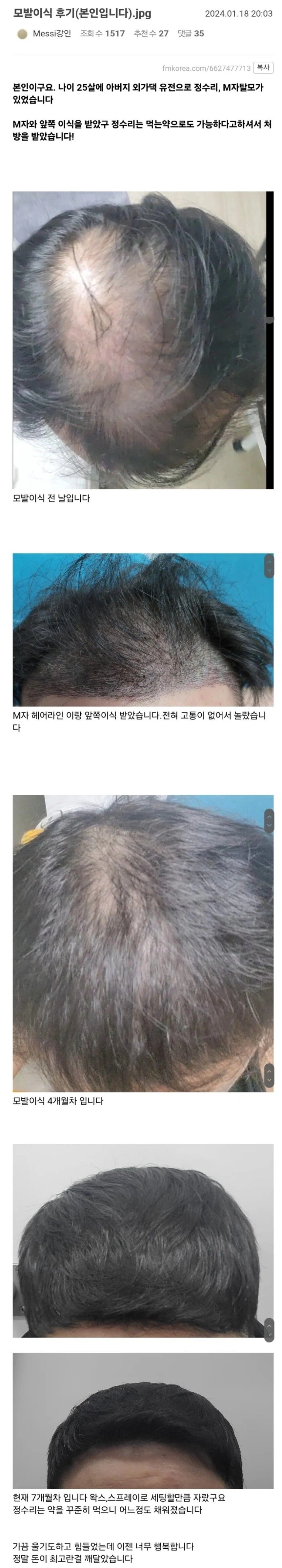 25살 유전탈모인의 모발이식 후기
