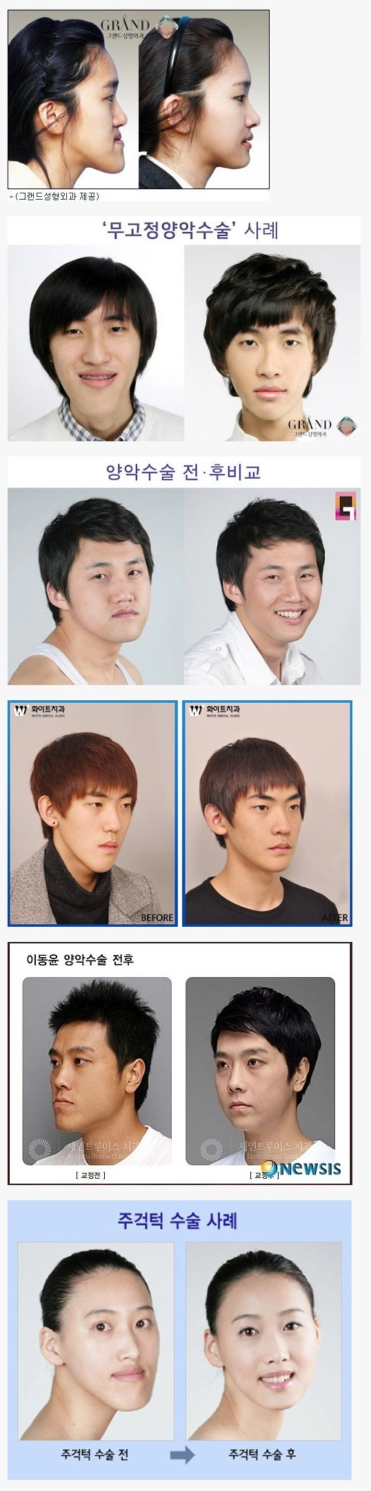 주걱턱 성형이 꼭 필요한 이유라는데