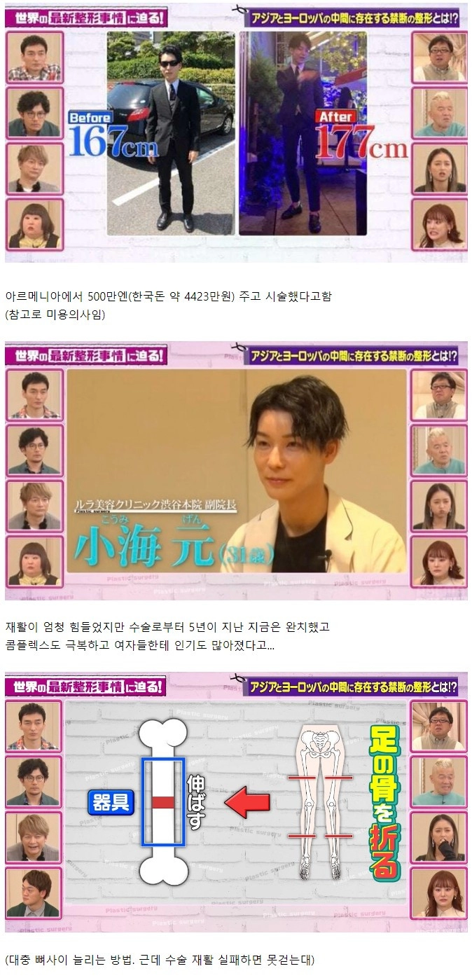 4400만원 수술로 167cm -> 177cm가 된 남자