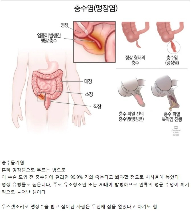 인류의 수명을 거의 두배로 늘려준 수술