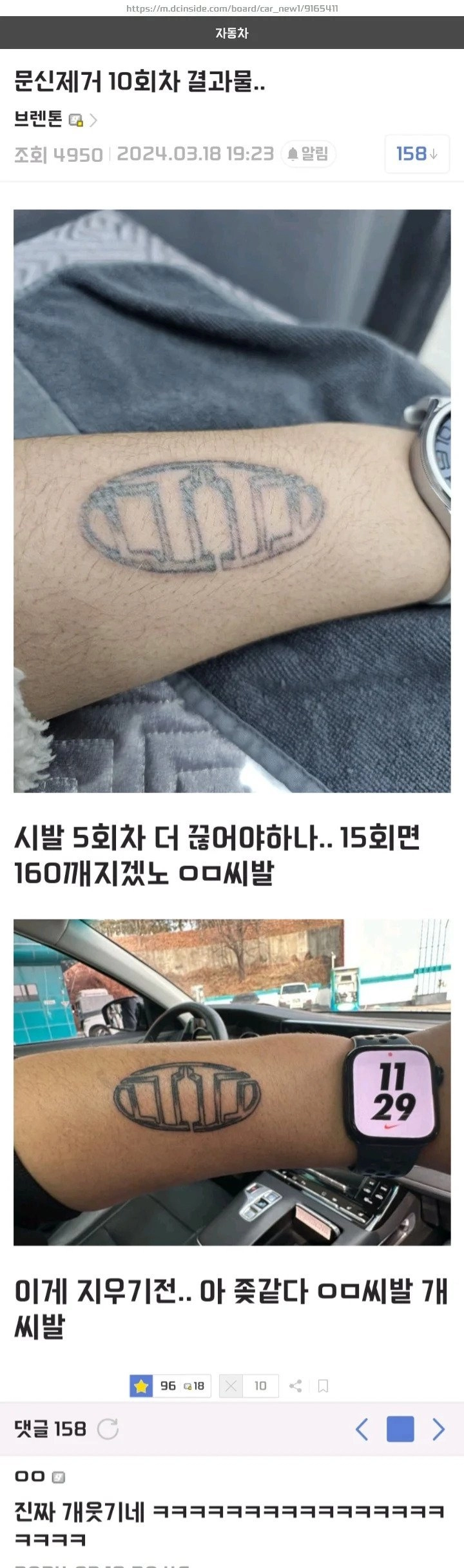문신제거 10회차인 차갤러