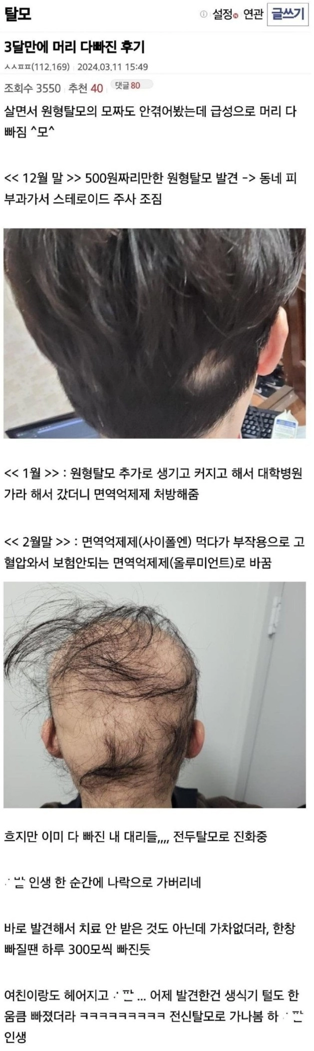 급성 탈모로 여친한테 차인 남자