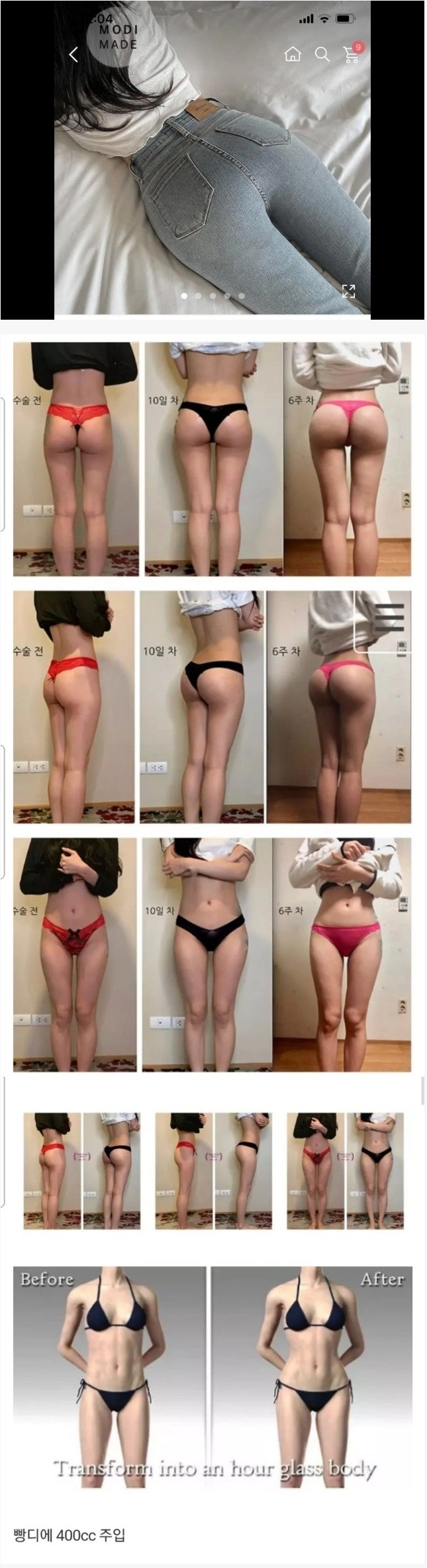 요즘 유행이라는 골반 수술 ㄷㄷㄷ