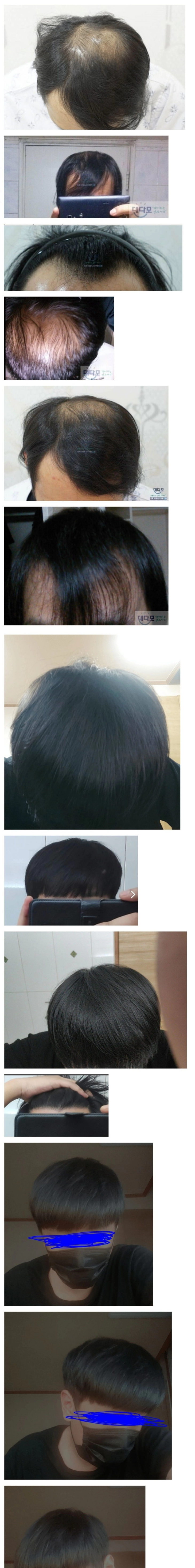 모발 이식에 천만원 투자 한 38살