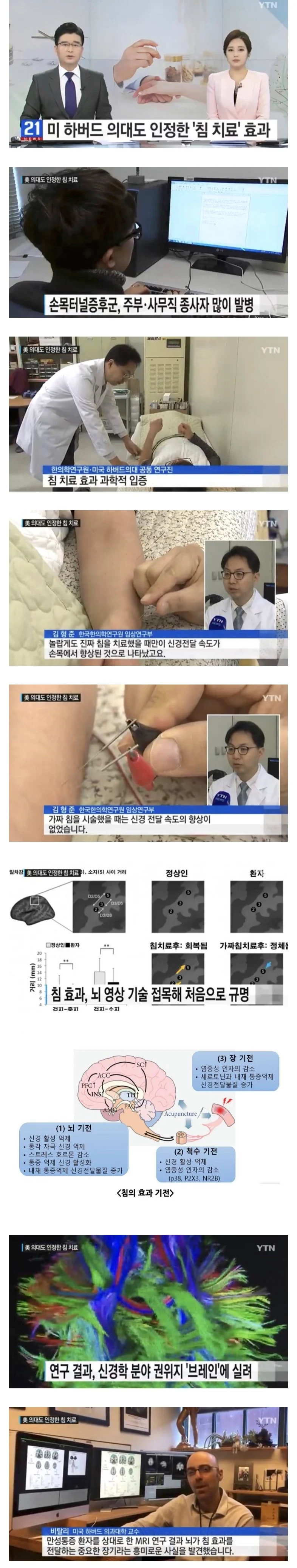 침술 ‘가짜가 아니었다’ 하버드 연구진이 인정한 한의학