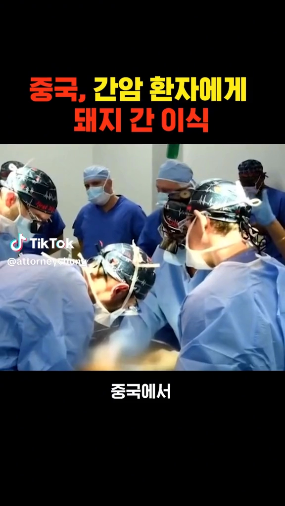사람에게 돼지간이식