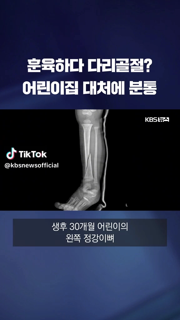 훈육하다 다리골절?